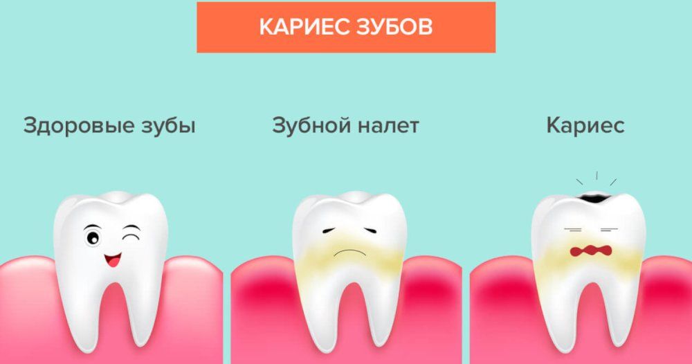 Кариес у детей