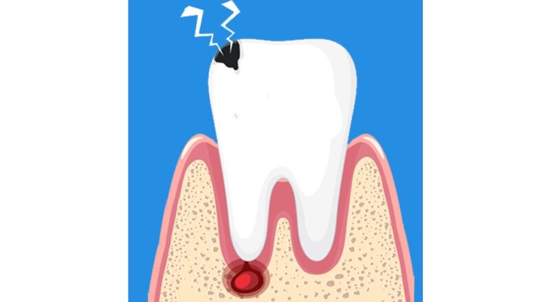 Лечение пульпита молочного зуба